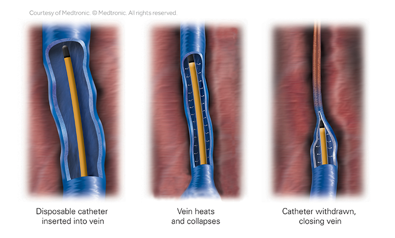 closurefast-step-1-3-catheter-vein-heat-removal Image of ClosureSeal thermal catheter
