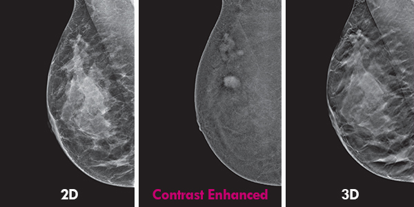 Contrast Enhanced Digital Mammography