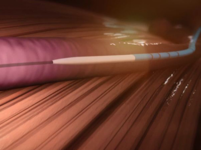 venaseal-step-1-tracking-to-location Image of VenaSeal