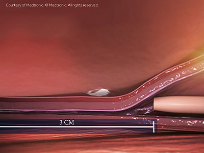 venaseal-step-2-remaining-aliquot-placement Image of VenaSeal