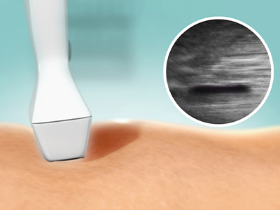 venaseal-step-3-external-compression-with-ultrasound Image of VenaSeal