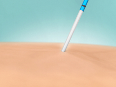 venaseal-step-4-catheter-removal Image of VenaSeal